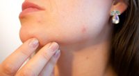 Comment debarrasser acne